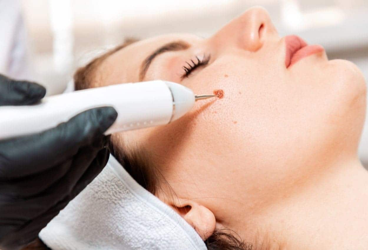 Benefits of Ephelides Treatment Portsmouth 