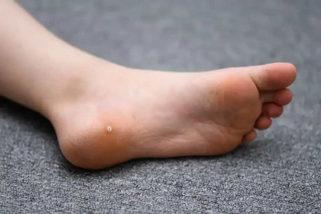 Image of verruca on the bottom of the foot that able to be treated with Cryotherapy Portsmouth 