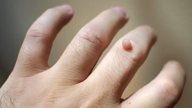 Image of blemish that Cryotherapy Portsmouth  can remove with Lipo 360.