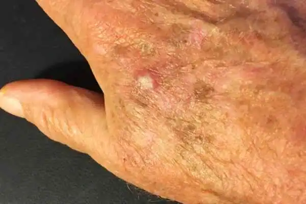 Image of Actinic keratoses Portsmouth  on a person hand