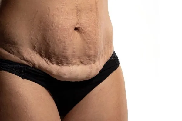 The science behind skin tightening Portsmouth  picture of a woman's sagging skin on the stomach