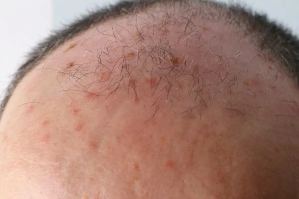 Actinic Keratoses Portsmouth 