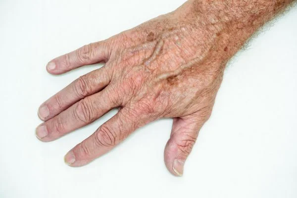 age spot removal Portsmouth 