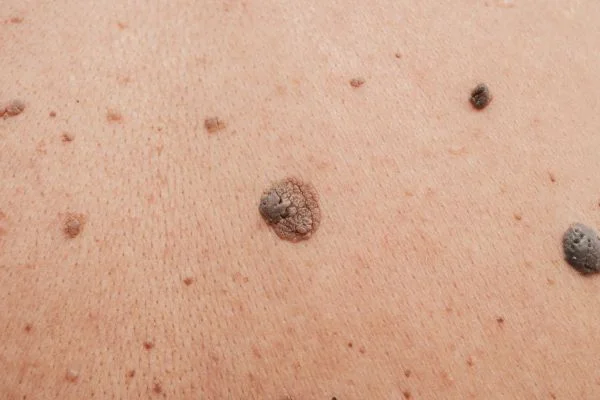 Benign Moles Portsmouth 