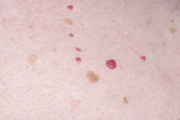 Cherry Angiomas Portsmouth 