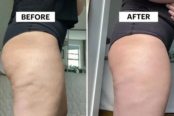 Body Sculpting Results Portsmouth 