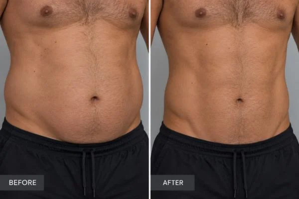 Body sculpting results Portsmouth 