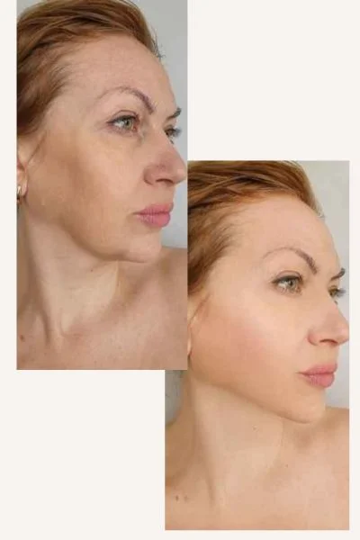 HIFU Results Portsmouth  before and after