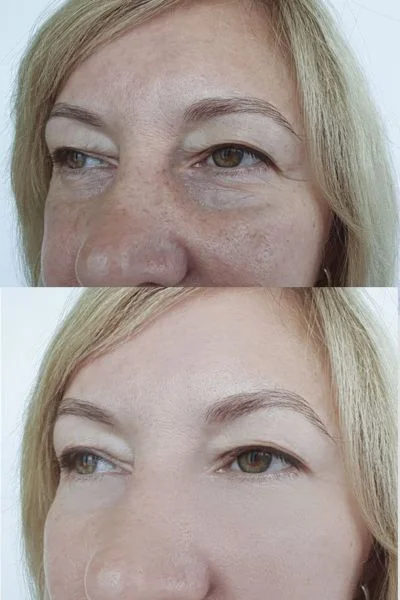 collagen lift 360 results Portsmouth 