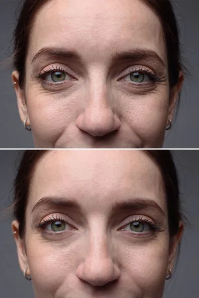 Collagen Lift 360 results Portsmouth 