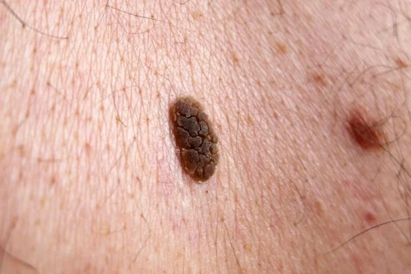 Seborrhoeic Keratoses removal Portsmouth 