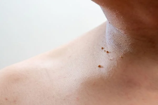 skin tag removal Portsmouth 